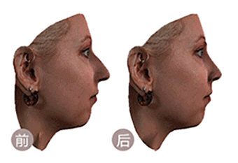 术前模拟整形手术