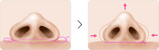 鼻翼肥厚、下垂
