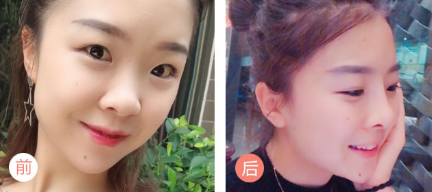 美莱线雕翘感美鼻