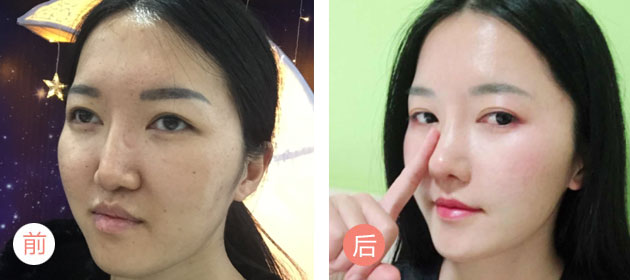 美莱3分钟极塑美鼻