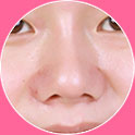 蒜头鼻