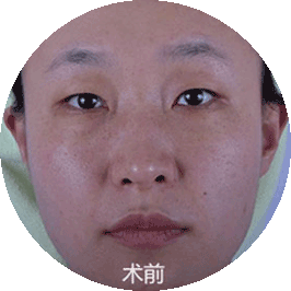线雕翘感美鼻