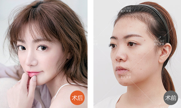 原生佳人弧线鼻