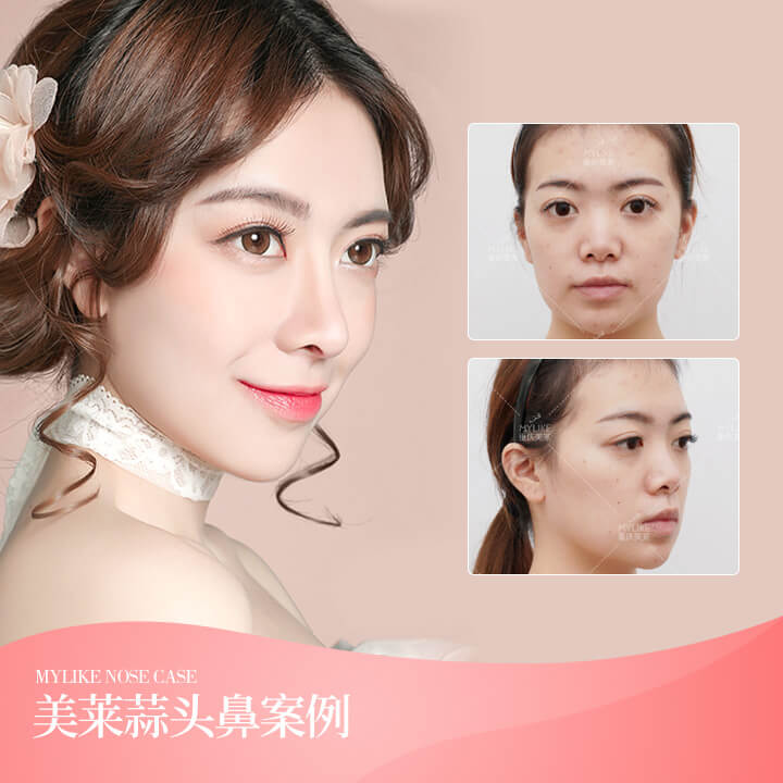 蒜头鼻案例