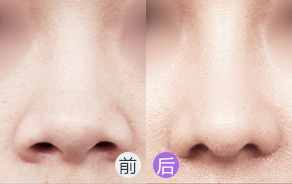 鼻翼肥厚