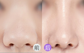 鼻翼宽大