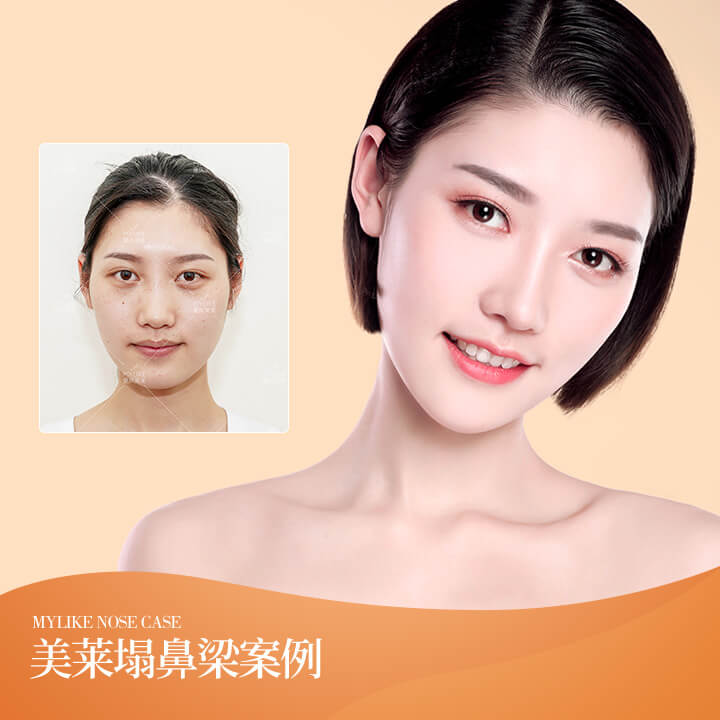 塌鼻梁整形案例1
