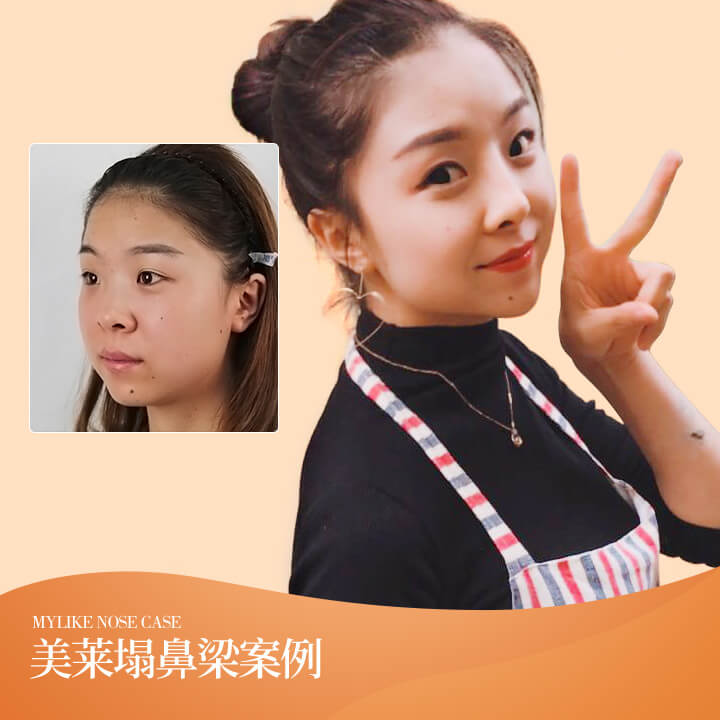 塌鼻梁整形案例2