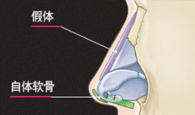 假体+自体组织隆鼻