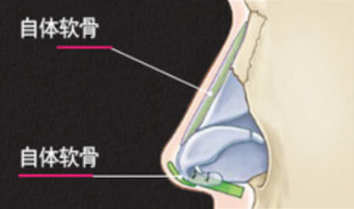 全自体软骨隆鼻