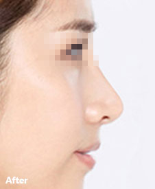 术后