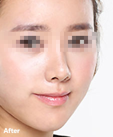 术后