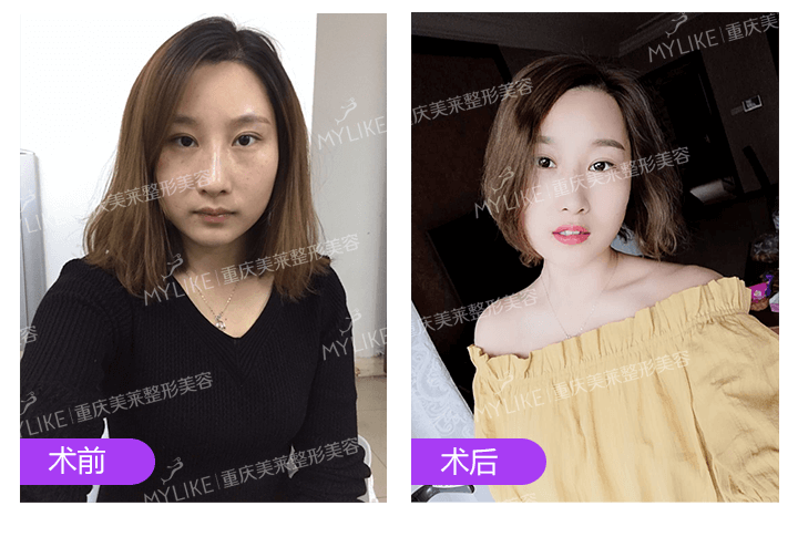 美莱纹唇案例