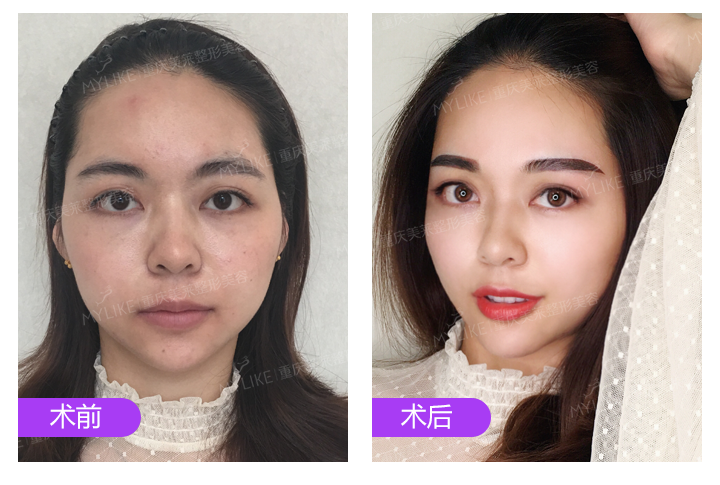 美莱纹唇案例