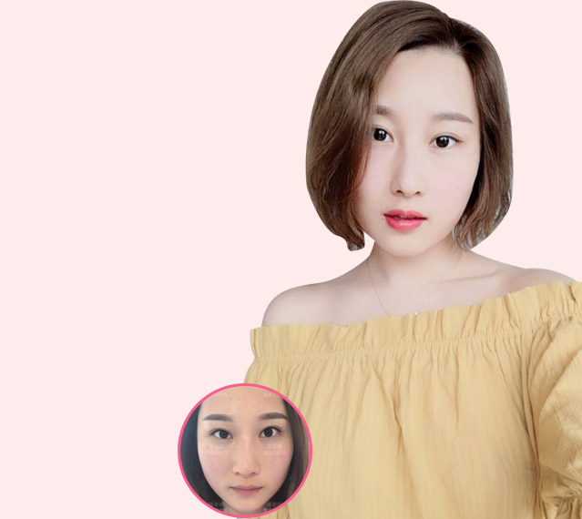 美莱纹唇案例