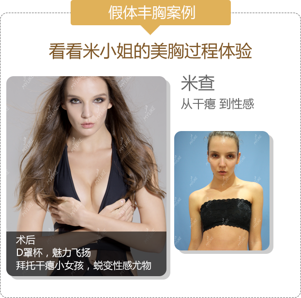美胸案例-米查