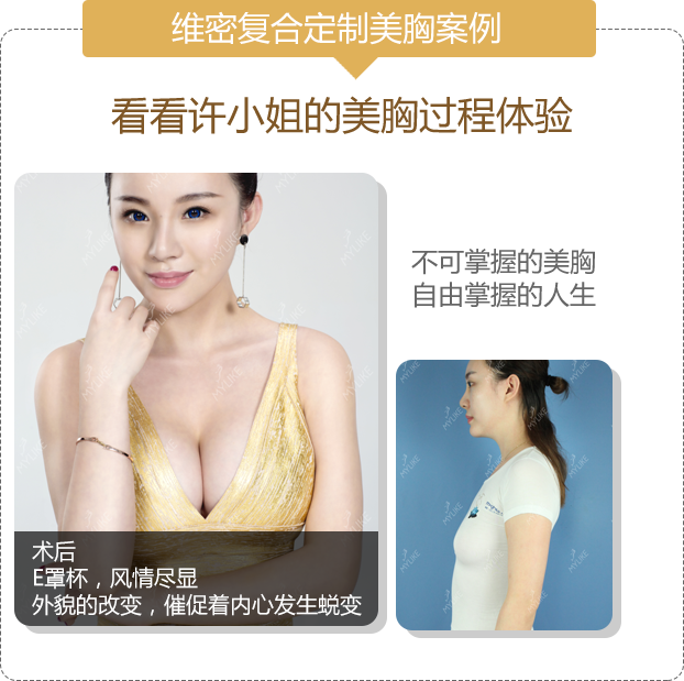 美胸案例-许言