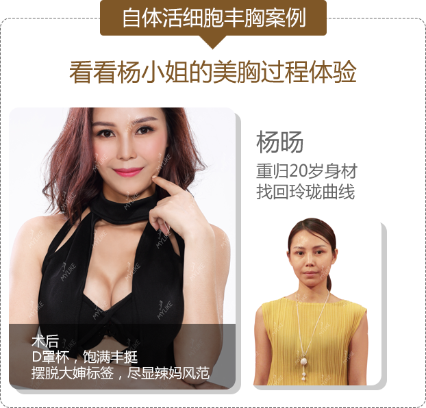 美胸案例-杨青