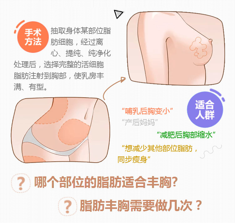 美莱自体活细胞丰胸