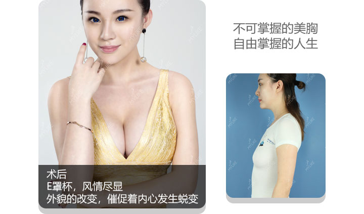 美莱丰胸案例—许言