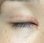 双眼皮留疤