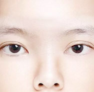 双眼皮不对称