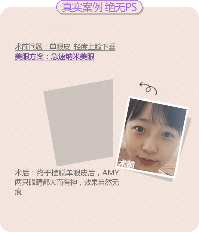 美莱双眼皮案例——华小姐