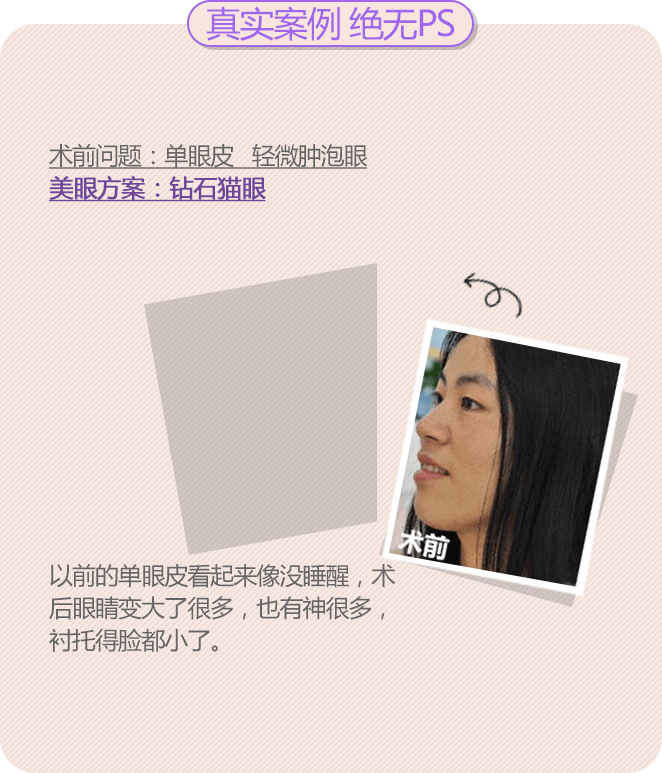 美莱双眼皮案例——AMY
